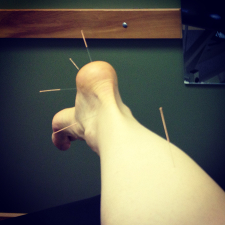 160425acupuncture